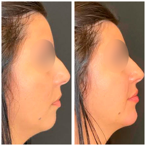 Dr. Moisés Wolfenson - cirurgião plastico em recife