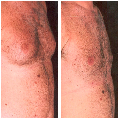 Dr. Moisés Wolfenson - cirurgião plastico em recife